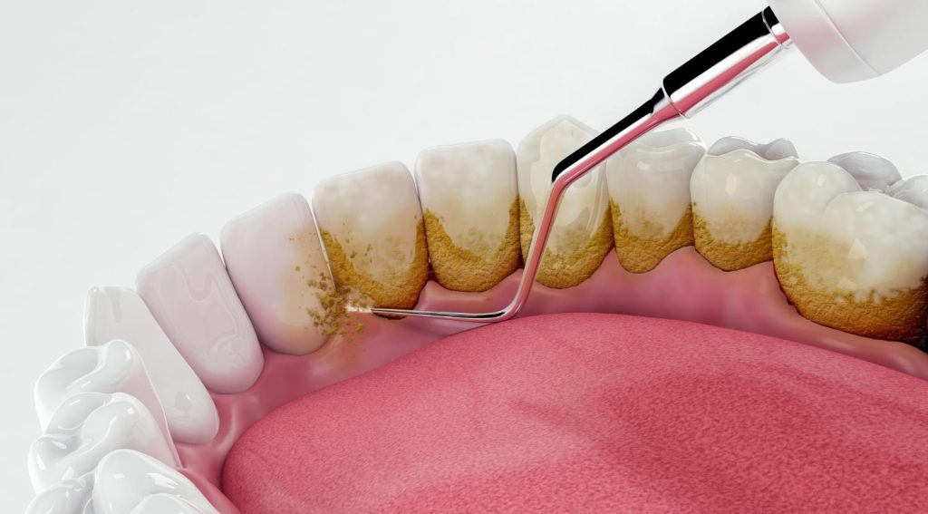 tooth plaque