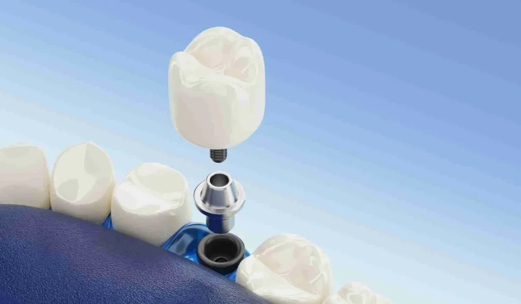 dental implant surgery