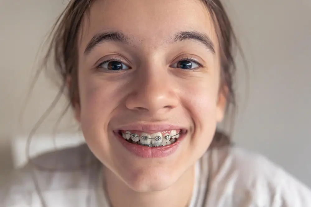 Close-up image of girl smiling with metal braces on. Braces in Sutton at Sherwood Park Dental in Surrey.
