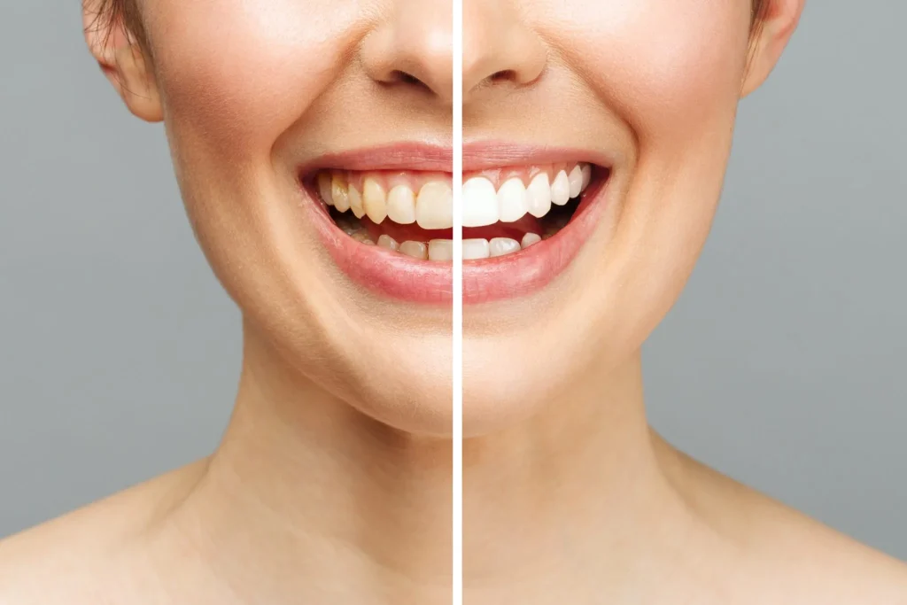 Before and after image of teeth whitening. Teeth whitening Sutton at Sherwood Park Dental Practice.